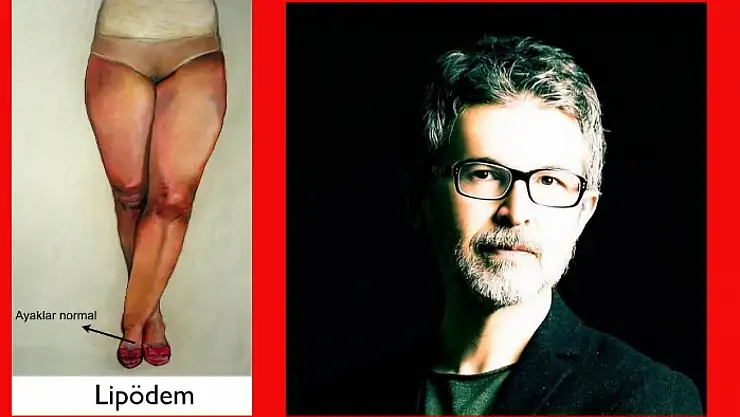 Menopozda Bel Simitlerinin Arkasındaki' Gizli Suçlu' Kilo Değil, Lipödem Olabilir mi?